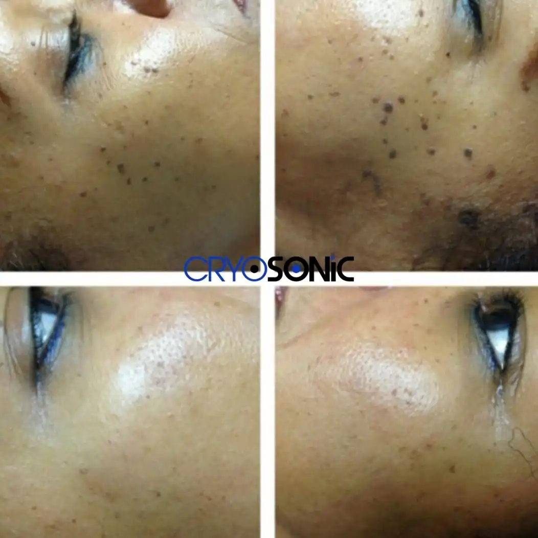Why Skin Shows Pigmentation After Treatment Barnsley