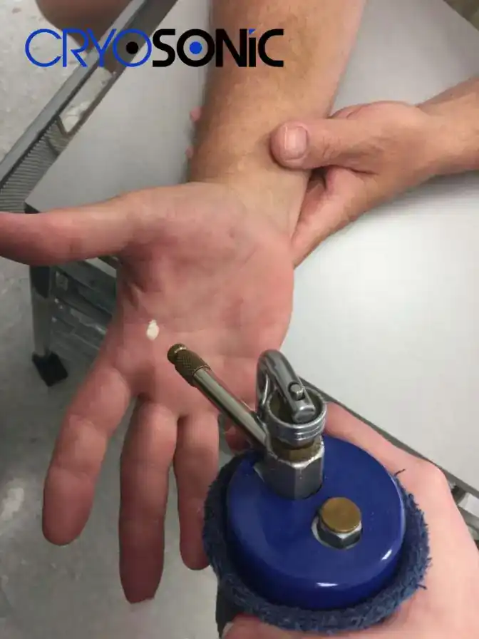 Temperature Differences: OTC vs Medical-Grade Cryotherapy Barnsley